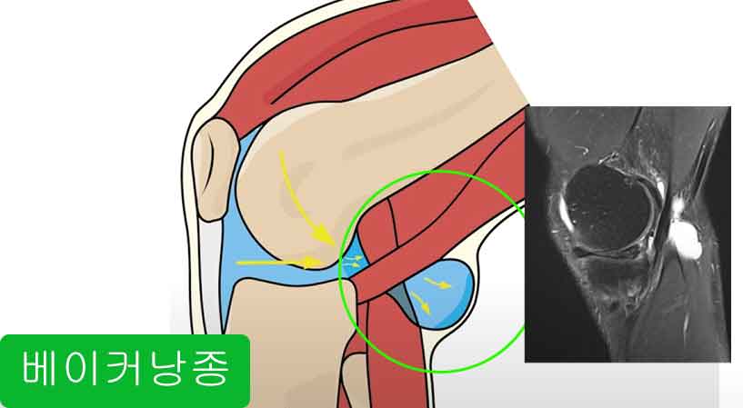 베이커낭종 진단 방법과 체크리스트