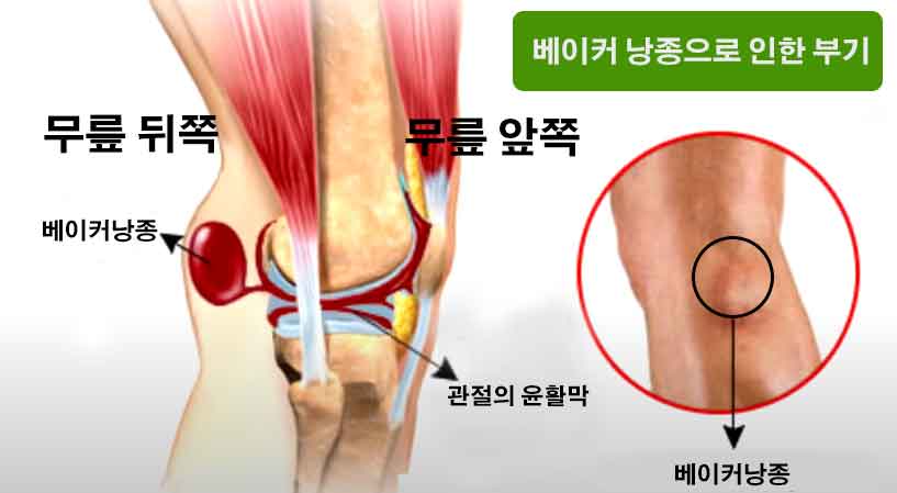 장염 중 피해야 할 음식들