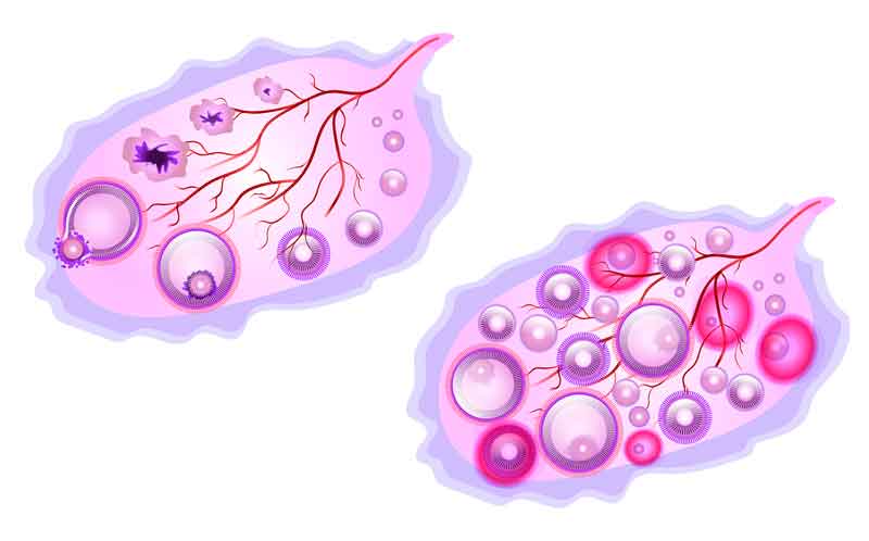 다낭성 난소 증후군(PCOS)과 생리불순