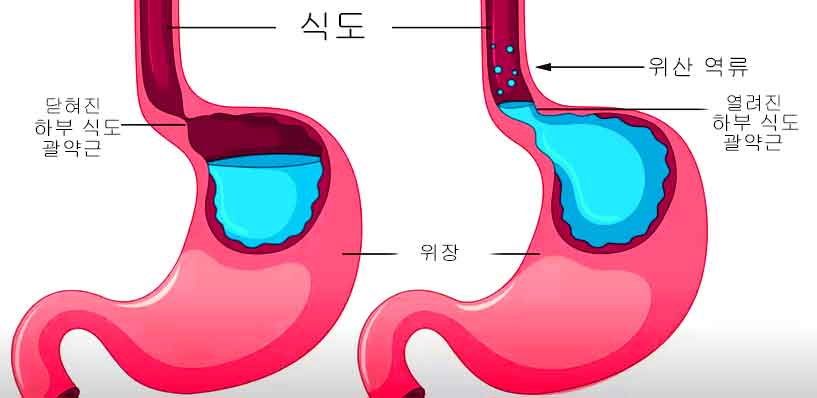 GERD와 역류성 식도염