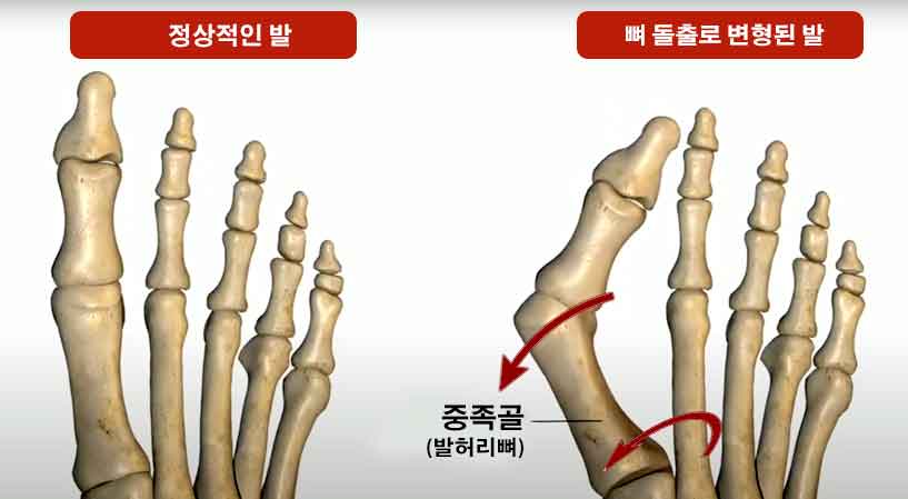 무지외반증 초기 증상과 자가 진단법