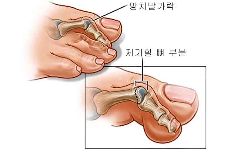 망치발가락, 수술적 치료법