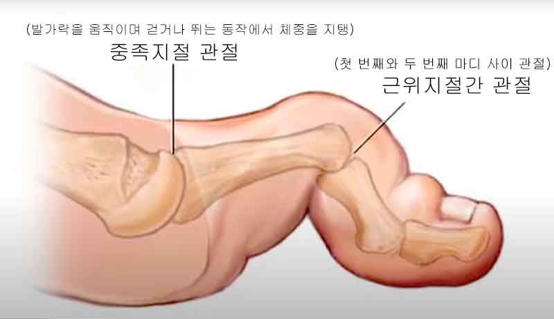 망치발가락, 정상 발가락과의 차이점