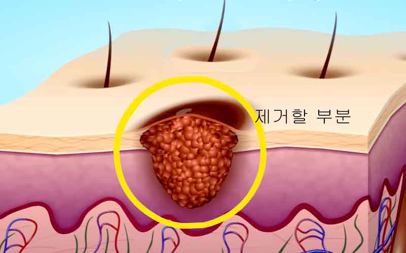 자외선과 흑색종의 관계