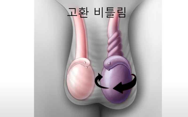 고환 통증의 주요 원인과 치료 방법 10가지: 고환 비틀림