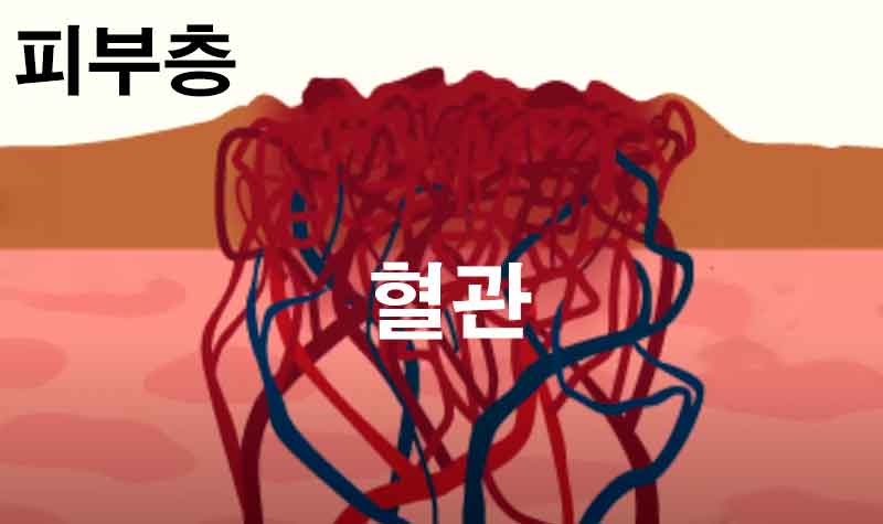 피부에 생긴 붉은 혈관 덩어리, 혈관종의 원인과 증상, 치료법