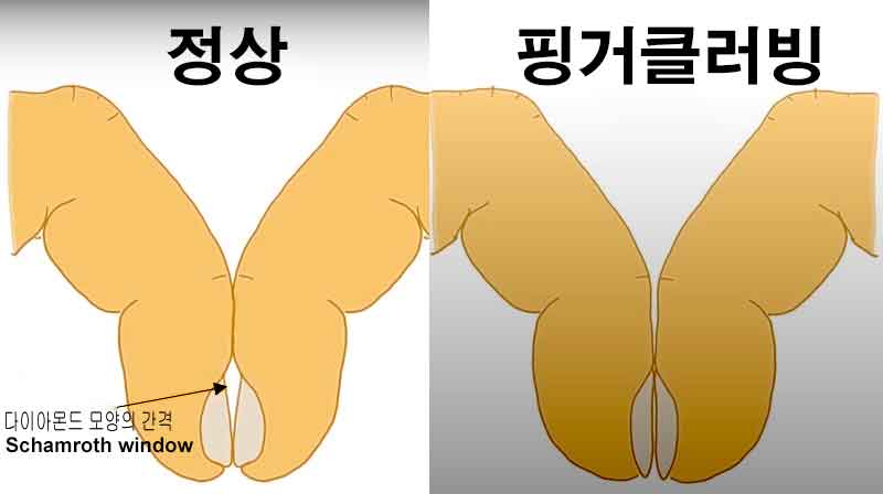 핑거클러빙의 원인과 증상, 단계별 핑거클러빙 진행 과정