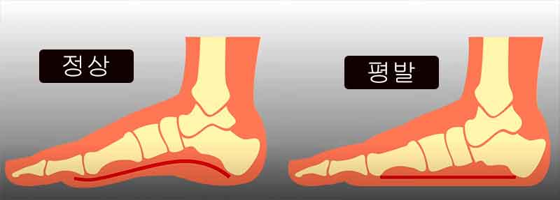 평발 편족 원인과 증상: 통증 완화와 효과적인 발 교정 방법