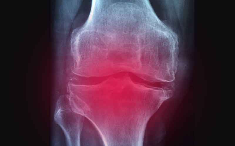 골관절염 초기 증상: X-ray, MRI를 통한 관절 상태 확인