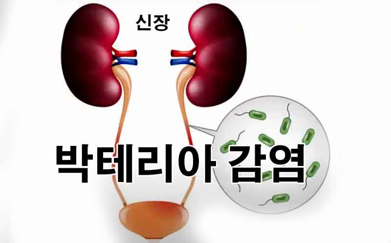 신우신염, 요로에서 신장으로의 감염 확산